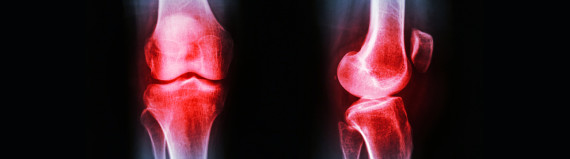 osteoarthritis-featured-img x-ray with knees highlighted