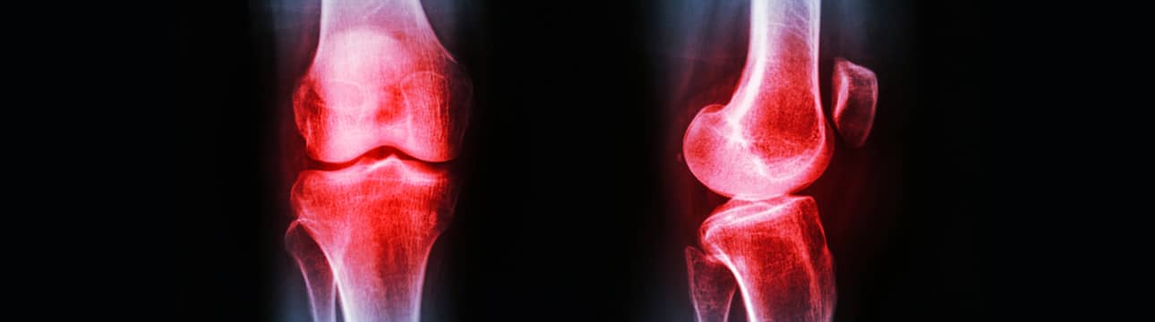 osteoarthritis-featured-img x-ray with knees highlighted