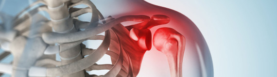 torn-rotator-cuff-featured-img x-ray with a torn rotator cuff