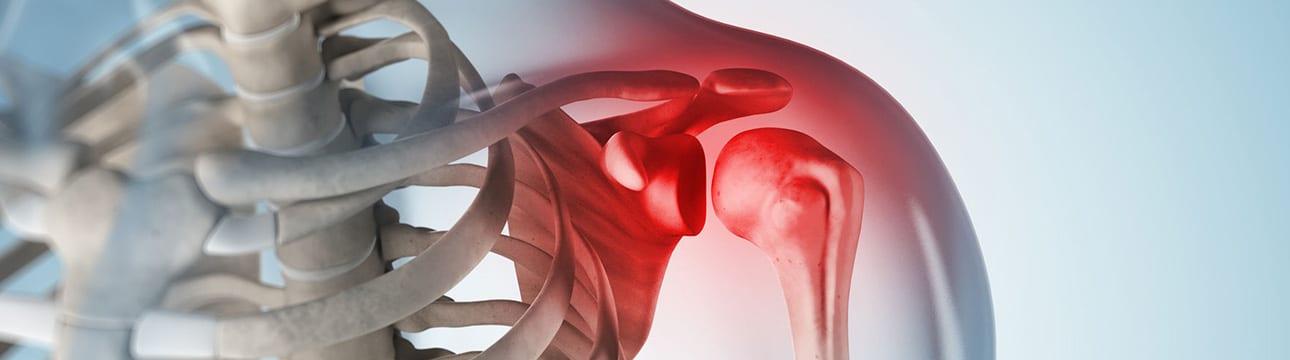 x-ray with a torn rotator cuff