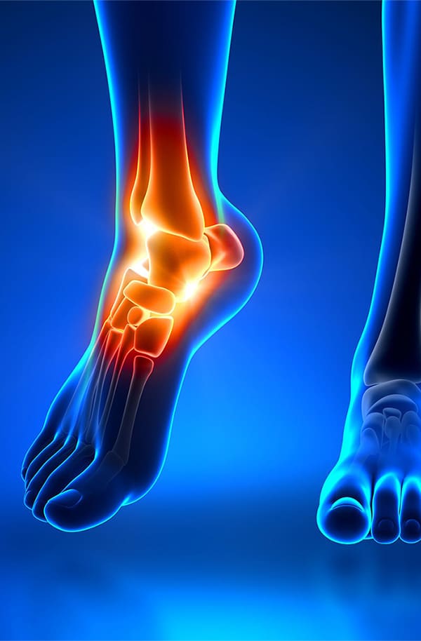 Ankle Pain