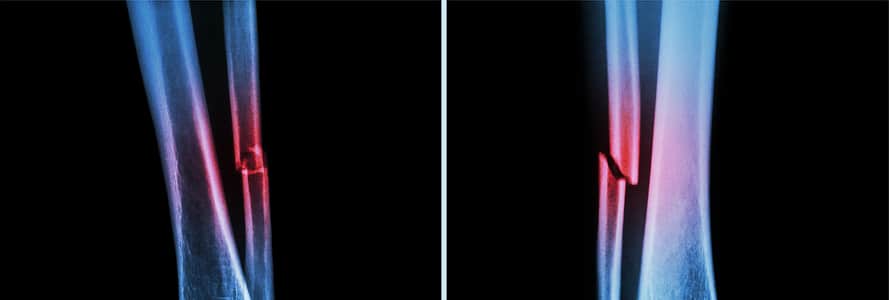 Fracture shaft of fibula bone ( leg bone ) . X-ray of leg ( 2 position : side and front view )