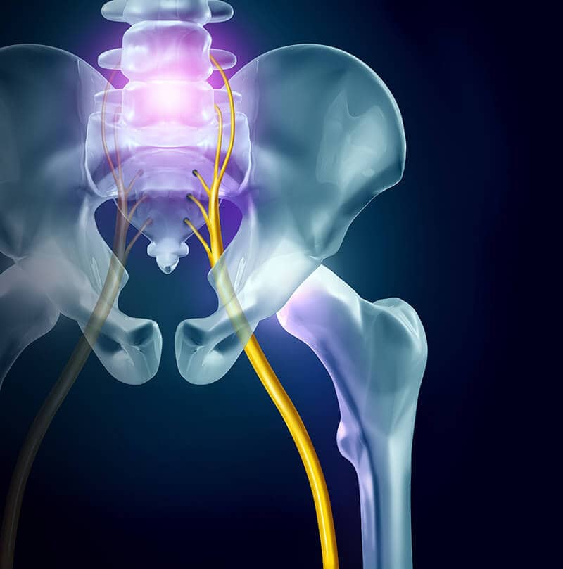 disc pressing against sciatic nerve