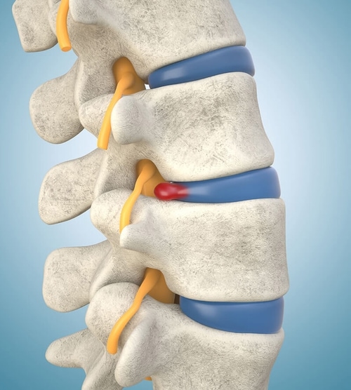 6216bb4c3f66cc2f7422388b_herniated-disc-illustration-p-500